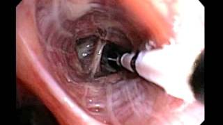 Bronchial Thermoplasty Improved Asthma Control for your Patients [upl. by Eniger16]