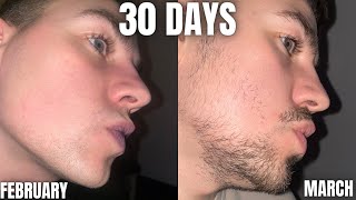 INSANE Beard growth in only 30 Days using MINOXIDIL and DERMA ROLLING [upl. by Arv]