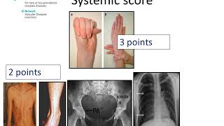 Marfan Syndrome  Diagnosis by Prof Julie De Backer [upl. by Air]