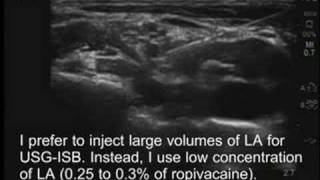 UltrasoundGuided Interscalene Brachial Plexus Block [upl. by Naitsirk]