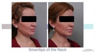 Double Chin Liposuction With Smartlipo™  Dr Sterry Explains [upl. by Anoved]