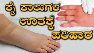 Edema Treatment  How To Cure Swelling In Hands amp Legs  ನೀರು ತುಂಬಿಕೊಂಡು ಮೈ ಕೈ ಊತ ನಿವಾರಣೆ ಹೇಗೆ [upl. by Allare524]