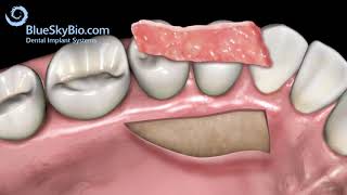 What is a gumgraft Understanding Gum Graft Surgery Advance Dental Implant and TMJ Center [upl. by Oirogerg]