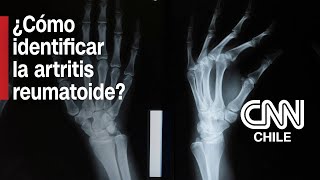 Traumatólogo cuenta cómo identificar la artritis reumatoide y qué tratamientos hay actualmente [upl. by Ripley]