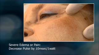 EndyMed PRO fractional skin resurfacing training video [upl. by Ahsinnek568]