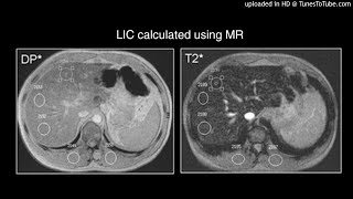 Cardiac and Hepatic Hemosiderosis as Measured by T2MRI [upl. by Seessel]