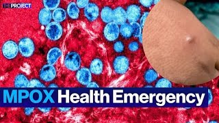 Why MPOX Is a Global Health Emergency [upl. by Amaty]