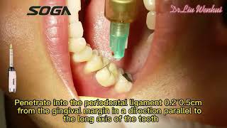 DrLiuwenhui——periodontal ligament injection [upl. by Newkirk416]