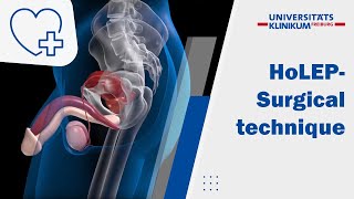 ANIMATION  Holmium Laser Enucleation of the Prostate HoLEP – „3 horseshoe technique“ [upl. by Adrea864]