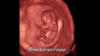 3D ultrasound at 11 weeks of pregnancy [upl. by Husein702]