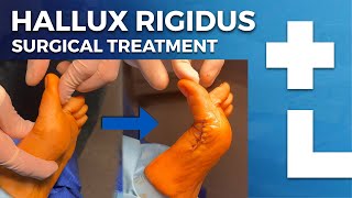 Hallux rigidus surgery  cheilectomy Moberg osteotomy  Dworska hospital® [upl. by Aicetal]