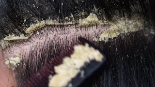 Dandruff scratching removal on head using black combing138 [upl. by Oneill]