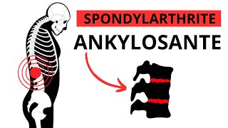 Spondylarthrite Ankylosante  Symptômes Causes Traitement [upl. by Viviane557]