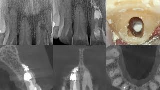 Treatment of an Internal Resorption Defect [upl. by Ailimac65]