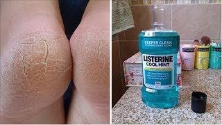 10 Amazing Uses For Listerine That Every Woman Should Know [upl. by Adnirod682]