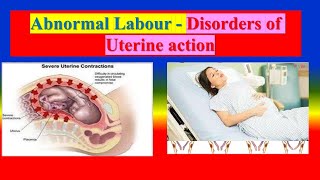 Abnormal Labour  Disorders of Uterine Action [upl. by Nebur]