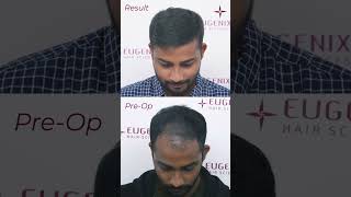 Hair Transplant Before After Your transplanted hair is permanent [upl. by Ayanej]