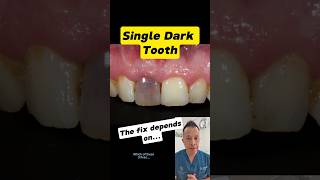 How to Fix a Discoloured Tooth Options Explained dentallan dentist shorts [upl. by Aninep495]