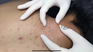 ACNE TREATMENT WITH VU QUYNH MI  Acne on Back amp Chest 2023p1 [upl. by Marcy]