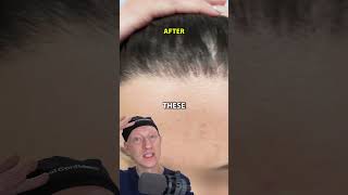 How I Got An INCREDIBLE Hairline Lowering Result [upl. by Zebada]