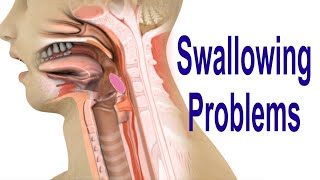 Swallowing Problems or Dysphagia Top 4 Possible Causes Including Cricopharyngeal Dysfunction CPD [upl. by Klenk]