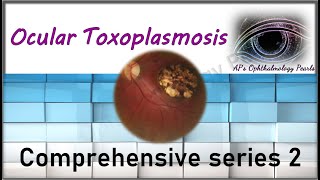 Ocular toxoplasmosis  Comprehensive series 2 [upl. by Patti]