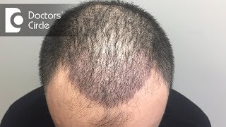 How long do hair transplants last  Dr Prashantha Kesari [upl. by Aitan805]