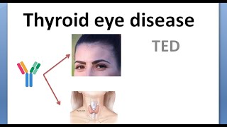 Ophthalmology 423 Thyroid Eye Disease Graves Exophthalmos Proptosis NOSPECS Classification Cause [upl. by Iahcedrom450]