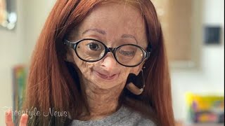 YouTube star Adalia Rose from Texas dies at 15 [upl. by Crystie928]