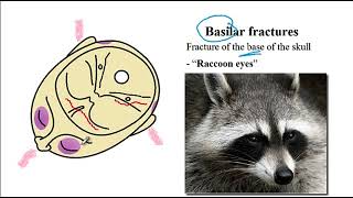 USMLE ACE Video 201 Basilar Skull Fracture [upl. by Lemyt53]