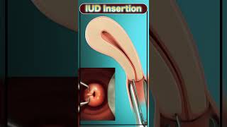 IUD insertion neet biology neetmotivation IUD motivation [upl. by Hjerpe355]