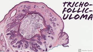 Trichofolliculoma Mother of All Hair Follicles 5Minute Pathology Pearls [upl. by Luanne]