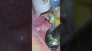 Dentist Performs Broken Tooth Dental Crown Procedure DentalCrown Dentist [upl. by Arimas]