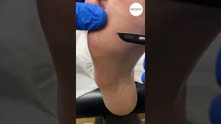 Callus removal from foot [upl. by Hterrag]