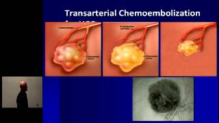 Hepatocellular Carcinoma Optimal Treatment and Transplantation [upl. by Anirok]