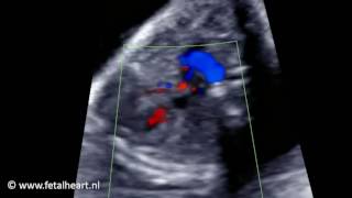 Fetal heart Academy  Tetralogy of Fallot 1 RVOT color Doppler [upl. by Holzman]