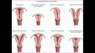 Congenital Uterine Abnormalities  CRASH Medical Review Series [upl. by Zaraf]