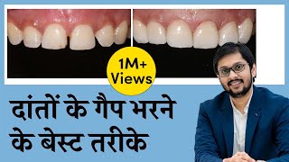 दाँतो के बीच की गैप को कैसे ठीक करें  CloseFill Gap In Teeth  Seraphic Dental Indore  Dr Ankit [upl. by Reinhard]