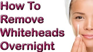 How To Remove Whiteheads Overnight  1 REMEDY To Remove Whitehead [upl. by Feerahs111]