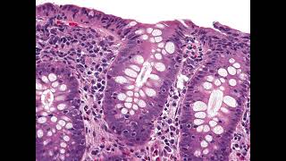 Lymphocytic colitis 7 [upl. by Pablo969]