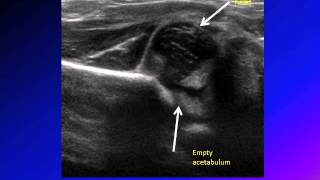 DDH developmental dysplasia of hip congenital hip dislocation CHD [upl. by Nagaer]