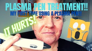 PLASMA PEN FIBROBLAST TREATMENT [upl. by Suirtimed]