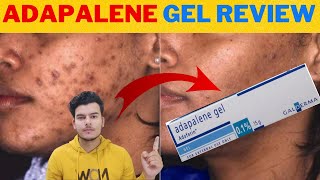 Adapalene Gel Adaferin 01 Review In Hindi  Best Gel For Removing Blackheads and Whiteheads [upl. by Arualana]