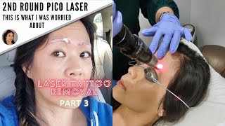 Another Microblading Removal Session What worked and What didntPart 3 [upl. by Bluh]