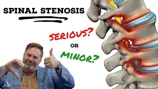 Is Spinal Stenosis serious  The Clinic Episode 1 [upl. by Cirederf149]