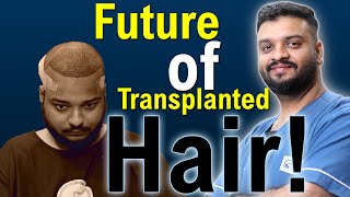 Will Transplanted HAIR fall out AFTER few years  Will they GROW BACK  Dr Vivek Galani  RQC [upl. by Hitchcock72]