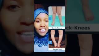 How to say knockknees and bowed legs in Swahili learnswahili swahili [upl. by Gow]