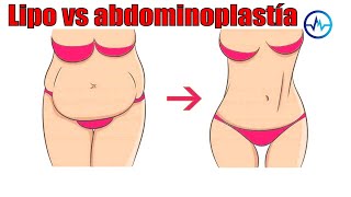 DIFERENCIAS entre ABDOMINOPLASTÍA y LIPOSUCCIÓN 🌹 DR ALBERTO CALVO 👸 MEDICINA EXTRAORDINARIA [upl. by Yznel478]