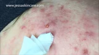 Acne Treatment Extractions  Acne Facial Protocol  Esthetician Education [upl. by Lothair]