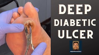 DEEP Diabetic Foot Ulcer podiatristfoot and ankle specialist treats a foot ulcer [upl. by Corissa]